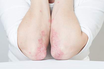 Treatment of Psoriasis and Psoriatic Arthritis Treatment with Stelara: A Path to Living Well